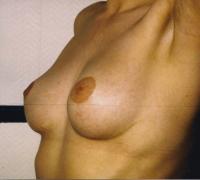 Remodelage seins