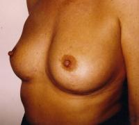 Remodelage seins