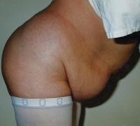 Abdominoplastie