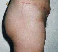 Abdominoplastie