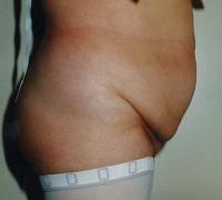 Abdominoplastie