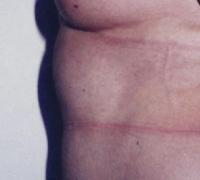 Abdominoplastie