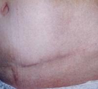 Abdominoplastie