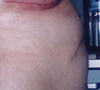 Abdominoplastie