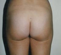 Liposculpture